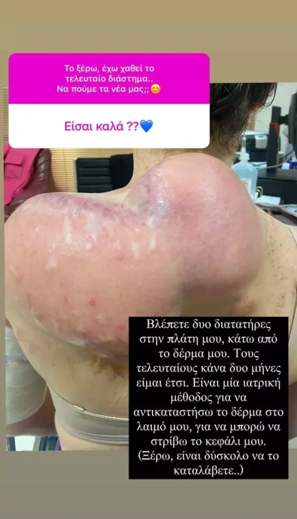 Η Ιωάννα Παλιοσπύρου δημοσίευεσε στο Instagram φωτογραφία της από την θεραπεία με διατατήρες στην οποία υποβάλλεται.